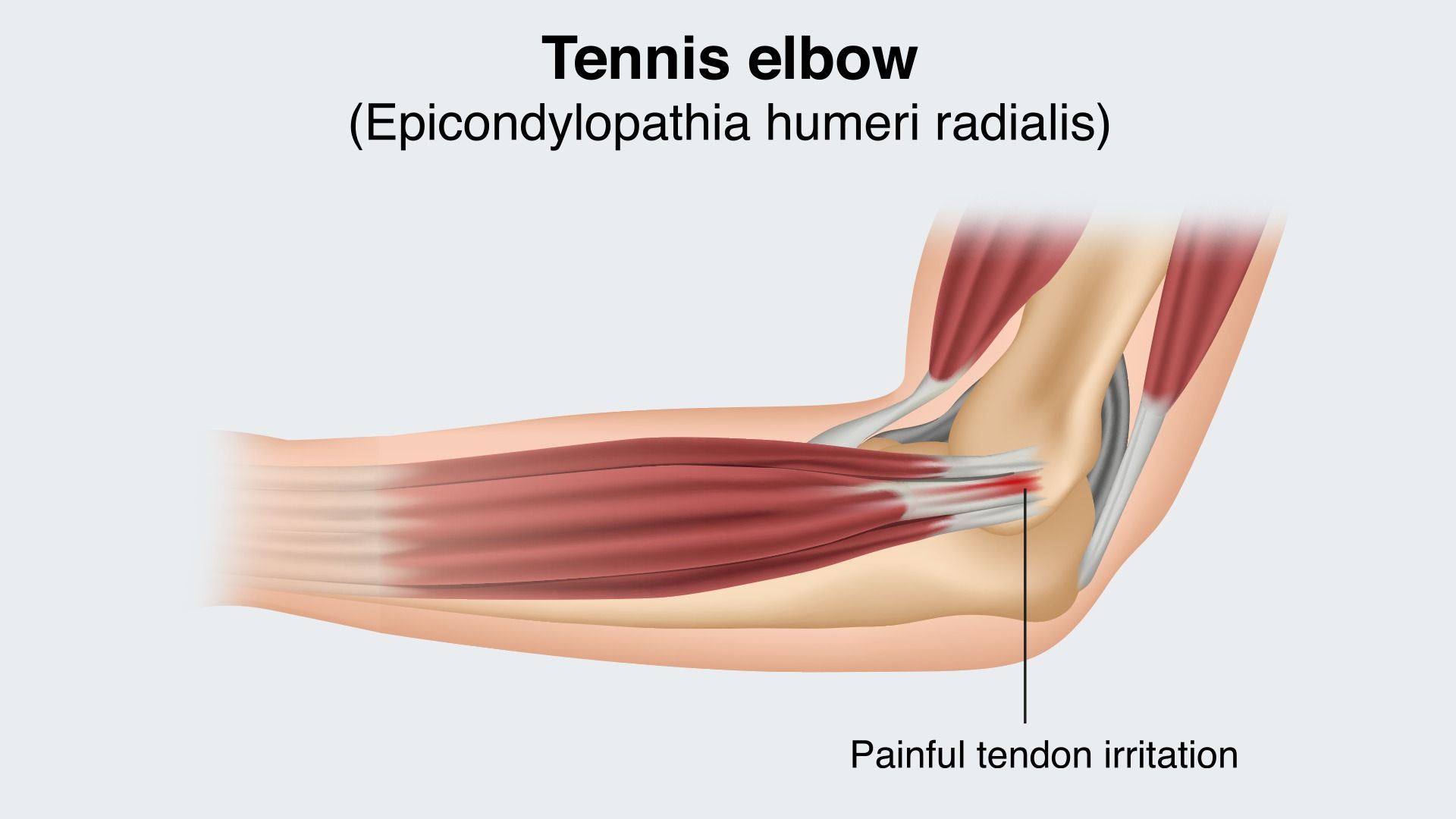 Tennis elbow – what is tennis elbow or golfer's elbow?